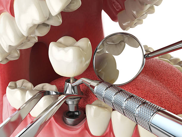Best Emergency Tooth Extraction in Marlton, NJ